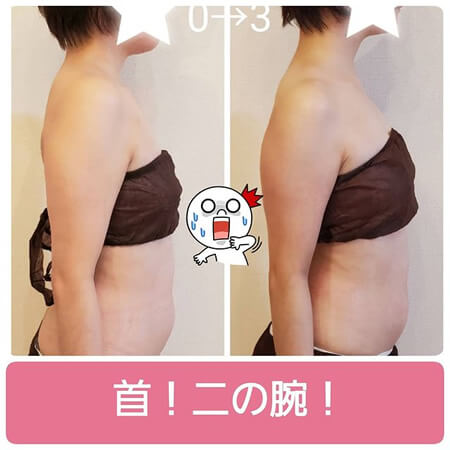 筋膜リリース痩身