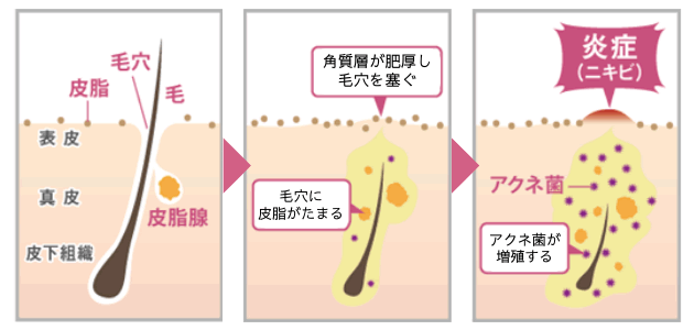 ニキビのメカニズム