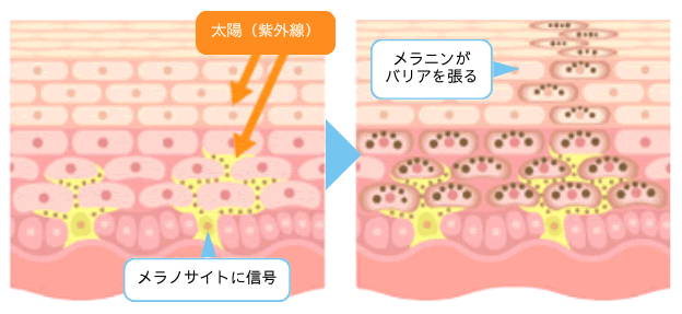 ニキビのメカニズム