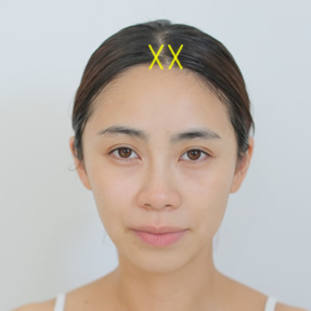 頭部へ