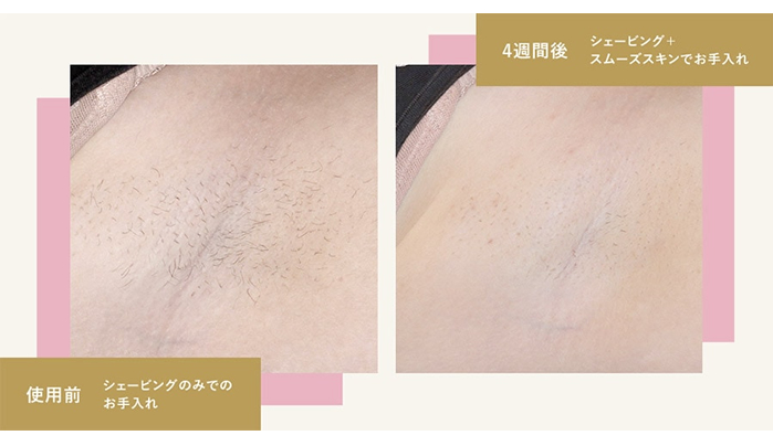 スムーズスキン ベアスマートの使用比較