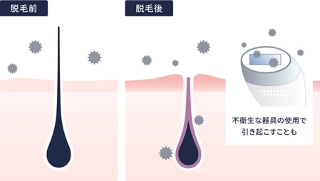 ステラボーテはいつでも簡単